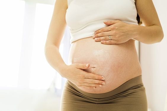 stretch mark pada ibu hamil